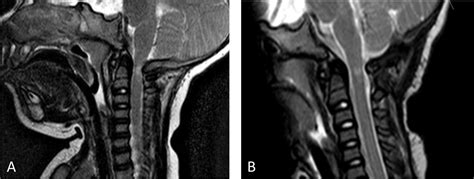 Foramen Magnum Mri