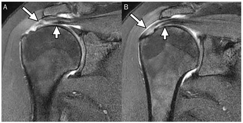 Diagnostics | Free Full-Text | Delaminated Tears of the Rotator Cuff ...