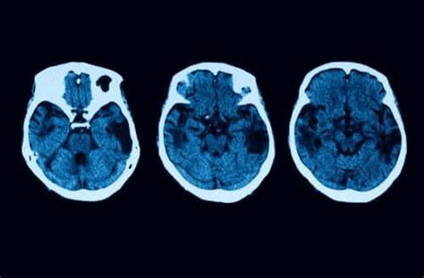 Posterior Cortical Atrophy Diagnosis and Treatment - Step To Health