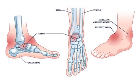 Talus Fracture | Dr Bijan 4 Feet