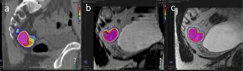 Consensus agreement map for GTVp. (a) CT, (b) 2D-MRI and (c) 3D-MRI ...