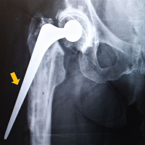 Cureus | Intriguing Periprosthetic Fracture of Hip Stem and Proximal ...