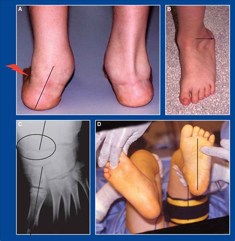 Foot and Ankle Deformities | Musculoskeletal Key