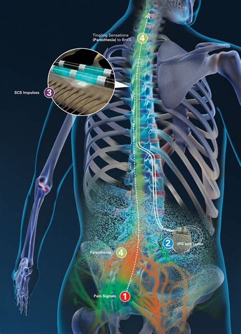 Abbott Spinal Cord Stimulator Manual