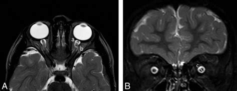 Normal Optic Nerve Mri