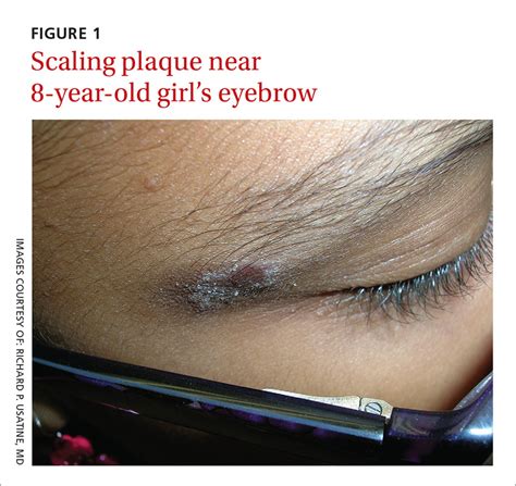 Rash on eyebrows and periumbilical region | MDedge Family Medicine