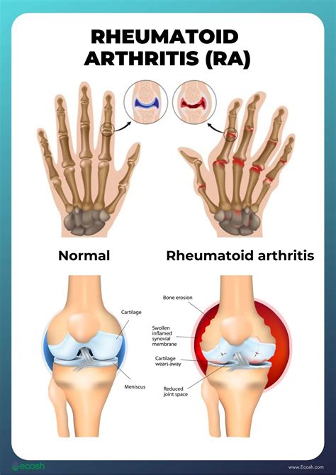 RHEUMATOID ARTHRITIS (RA) - Symptoms, Causes, Risk Groups, Treatment ...