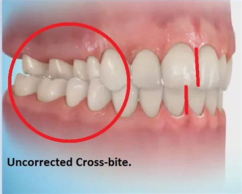 Correction of Cross-Bites / Use of Expanders - Clonmel Orthodontics