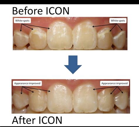 How To Prevent White Spots On Teeth - Rowwhole3