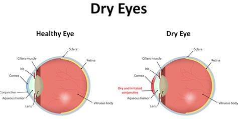 Dry Eye Syndrome - La Pine Eyecare Clinic