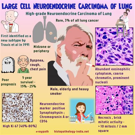 Pathology of Large Cell Neuroendocrine Carcinoma of Lung | Pathology ...