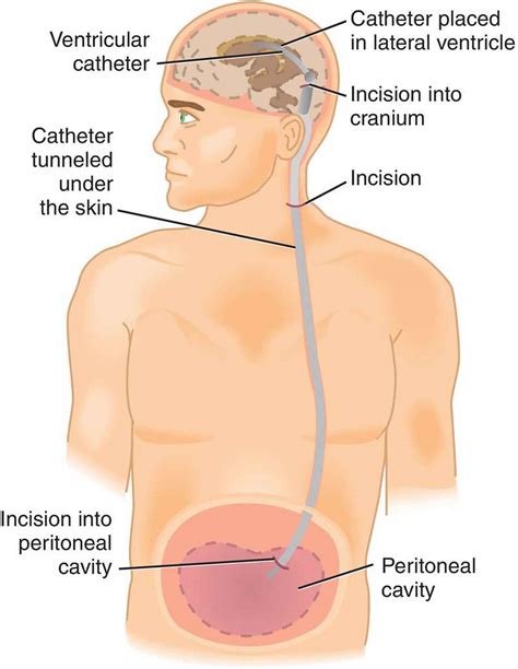 vp shunt placement cpt code - benshapirobirthchart