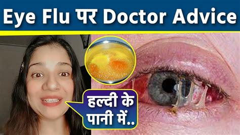 Eye Flu Ayurvedic Treatment | Eye Flu Home Treatment In Hindi | Eye Flu ...