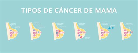 ¿Cáncer de mama o mastitis? Conoce las enfermedades de la mama para ...