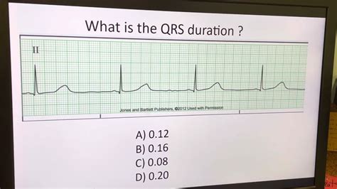 Telemetry Analysis: Video 2: Measuring the Duration of the QRS Complex ...