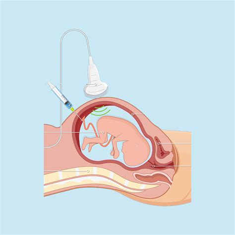 Terapia Fetal – Neofetal México