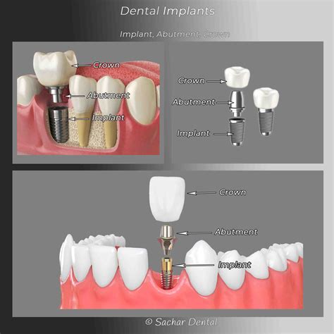 How is a crown attached to a dental implant - Dental News Network