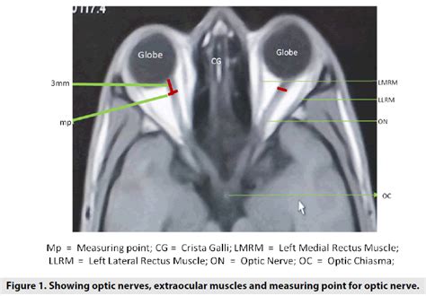 Magnetic Resonance Imaging Nomogram For Optic Nerve And Extraocul