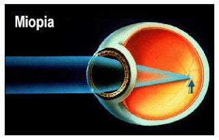 SALUD: Miopía progresiva