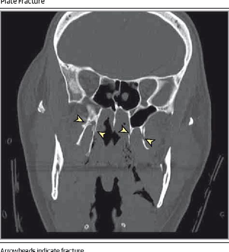 Medial Pterygoid Plate