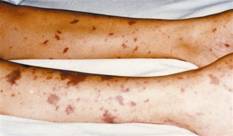 Meningitis: Symptoms, Treatment, Causes, Rash Pictures - YouMeMindBody