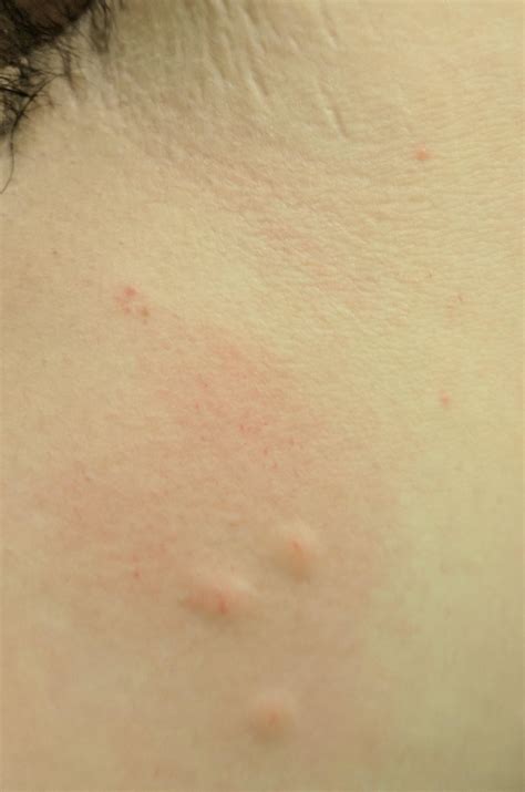 Does this triangle bite mean I have bedbugs? : r/Bedbugs