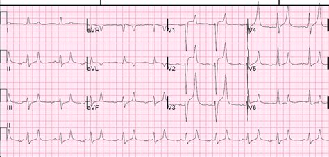 Dr. Smith's ECG Blog: Hyperkalemia and ST Segment Elevation, Post 1