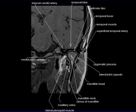 Temporomandibular Joint Anatomy | MRI TMJs Anatomy | Free Sagittal ...