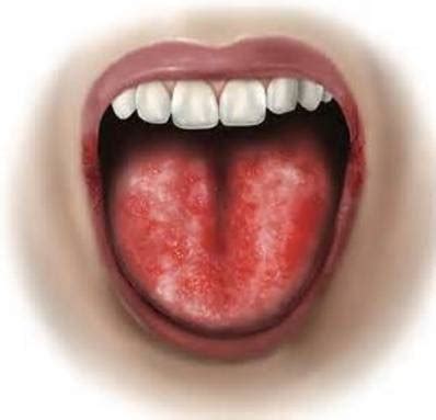 5 Common Causes of Burning Tongue | UTOdent.con