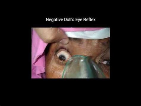 Doll's Eye Reflex By Dr Bilal khanzada - YouTube