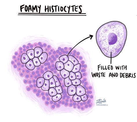 Foamy histiocytes - Pathology dictionary - MyPathologyReport.ca