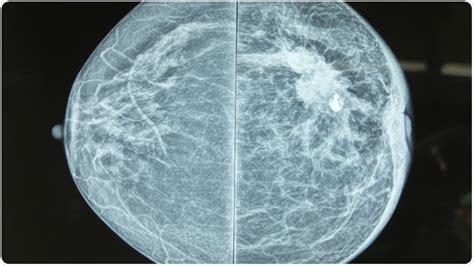 Thermography versus Mammography: Which is Best? - Vaccar.biz