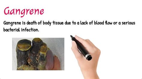 Gangrene ||Types of Gangrene||Causes of Gangrene - YouTube