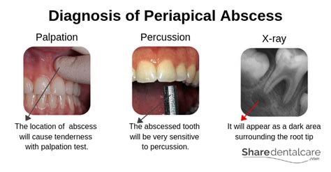 Periodontal Abscess Vs Periapical Abscess