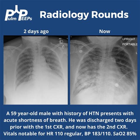 Avraham Z. Cooper, MD on Twitter: "RT @PulmPEEPs: We have another # ...