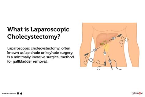 Laparoscopic Cholecystectomy: Treatment, Procedure, Cost, Recovery ...