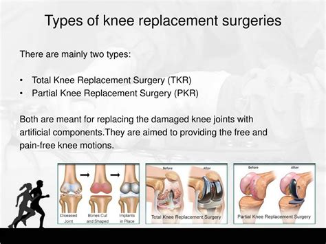 Total Knee Replacement Types