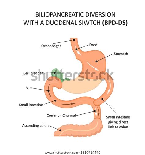 38 Duodenal Switch Images, Stock Photos & Vectors | Shutterstock