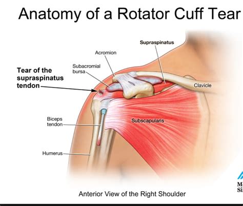 Anatomy of a rotator cuff tear Archives - Arizona Institute for Sports ...