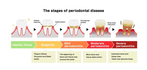 Periodontal Procedures – PerioClinik Dr. Freddy Fokam