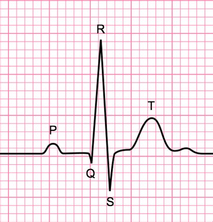 Normal Ecg Tracing