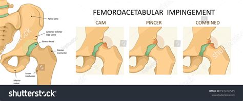 56 Femoroacetabular Images, Stock Photos & Vectors | Shutterstock