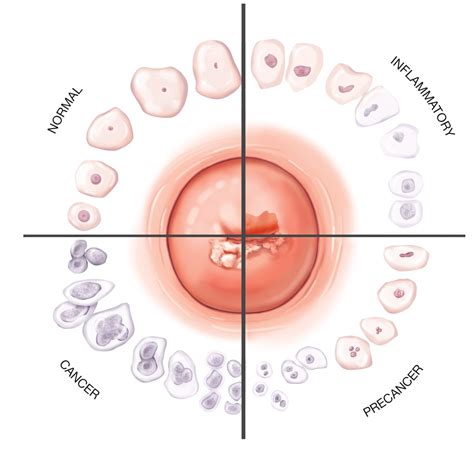 Cervical cancer genital human papillomavirus infection human papilloma ...