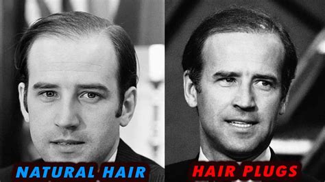 Joe Biden Old School Hair Plugs and Hair Loss Story