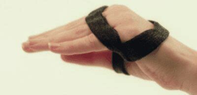 Splinting for Ulnar Claw | Merivale Hand Clinic