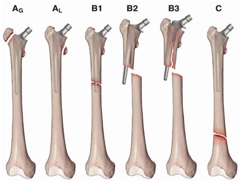 Fixation of Periprosthetic Fractures About/Below Total Hip Arthroplasty ...