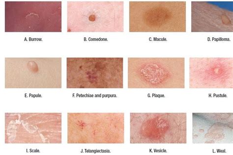 macules vs papules - Google Search | Wound care, Wound care nursing ...