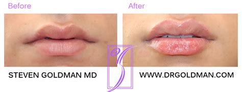 Lip Flip vs Lip filler - Beachwood Plastic Surgery and Medical Spa