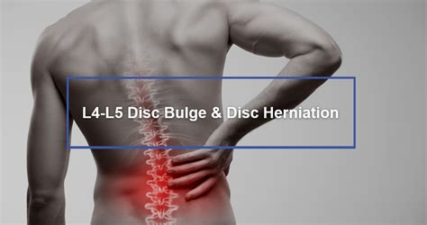 L4-L5 Disc Bulge & Disc Herniation - Dr. Kevin Pauza, The Discseel ...