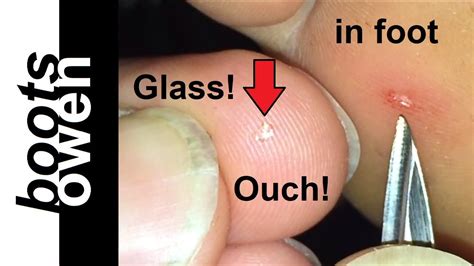 How to remove a TINY shard of glass embedded in foot: try this one ...